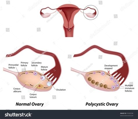 Normal Ovarian Cycle And Polycystic Ovary Syndrome Leading Cause Of