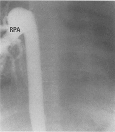 A Kawashima Operation With Right Sided Azygos And Right Superior Caval