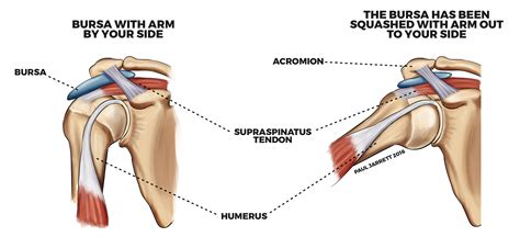 Shoulder Impingement Bursitis Murdoch Orthopaedic Clinic