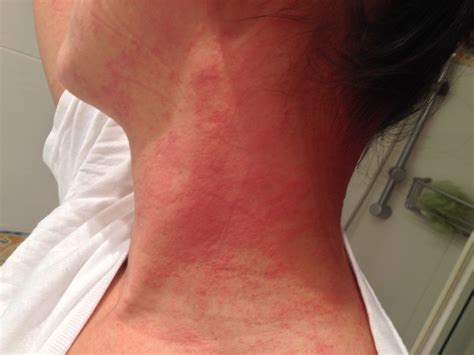 This is the first out of the most effective home remedies for hives on neck and face that i want. Dramatic rash caused by consuming Shiitake mushrooms #ShiitakeDermatitis