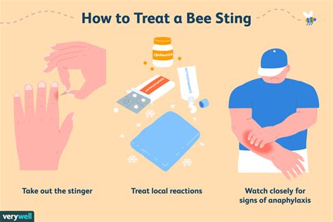 Bee Sting Treatment Minor And Severe Reactions