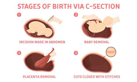 what s better natural birth or a c section