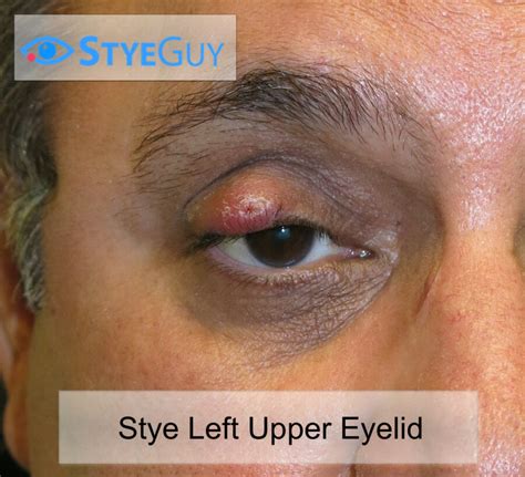 Stye Styeguy Get Fast Treatment For A Stye On An Upper Eyelid