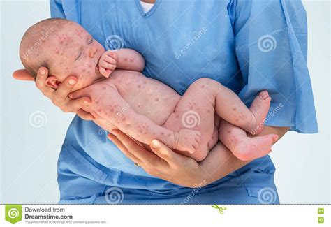 Doctor Holding A Newborn Baby Which Is Sick Rubella Or Measles Stock