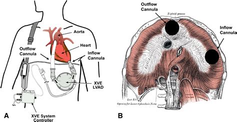 Diaphragmatic Hernias After Sequential Left Ventricular Assist Device