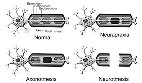 Neurapraxia Nerve Contusion Axonotmesis Crushed Nerve Neurotmesis