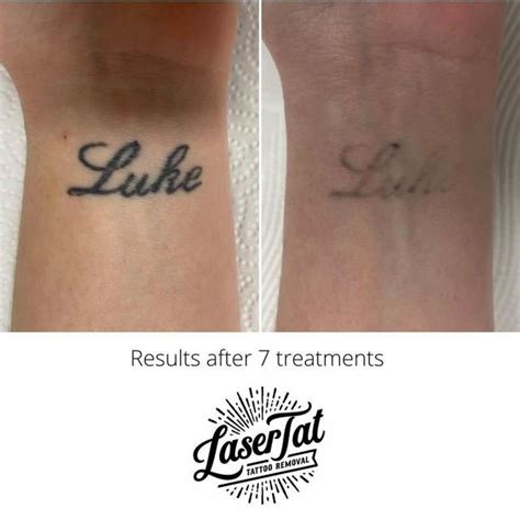 Laser Tattoo Removal How Long Until You Can See Results — Lasertat