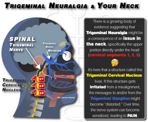 Trigeminal Neuralgia Treatment In Charlotte Nc