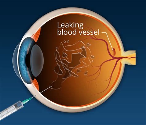 Fda Approved For Macular Degeneration Treatment