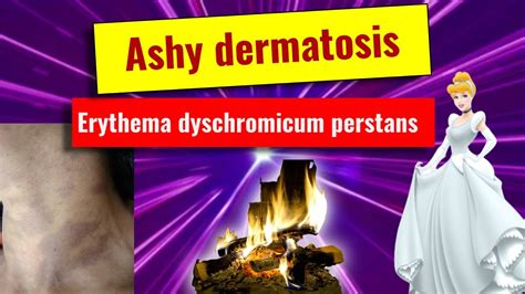 Ashy Dermatoses Erythema Dyschromicum Perstans Overview Features
