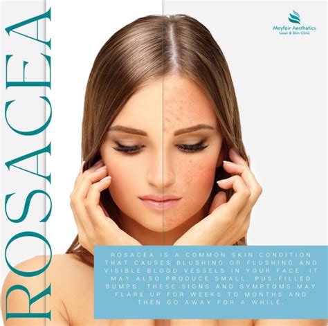 Rosacea Treatment Options Mayfair Aesthetics