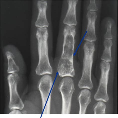 Enchondroma Benign Bone Tumor Tumors Of Bone