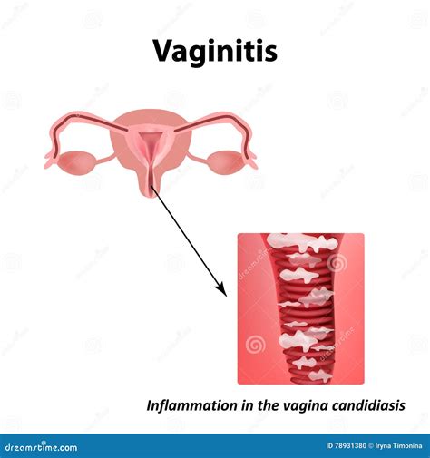 Vaginitis Inflammation In The Vagina Candidiasis Thrush The Structure