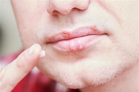 The herpes simplex virus (hsv) causes herpes. Herpes Is Lip Simplex Symptoms Herpes Face _ Slus Contagious Multipartes