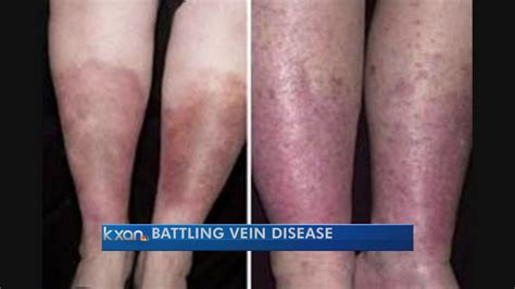 New Vein Disease Treatment Arrives In Austin Youtube