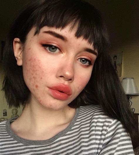 𝚖𝚒𝚖𝚒𝚛𝚛𝚘𝚛𝚛;𝚙𝚒𝚗𝚝𝚎𝚛𝚎𝚜𝚝 | Girl with acne, Makeup inspiration, Skin