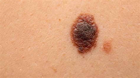 Black Mole Melanoma Skin Cancer