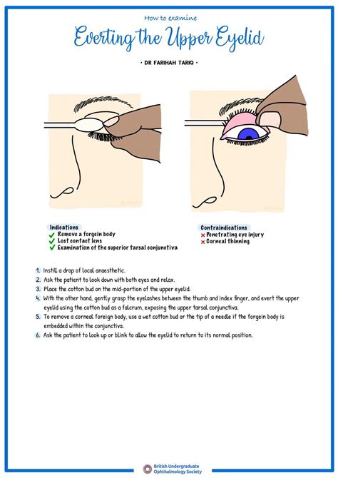 How To Evert The Upper Eyelid British Undergraduate Ophthalmology Society