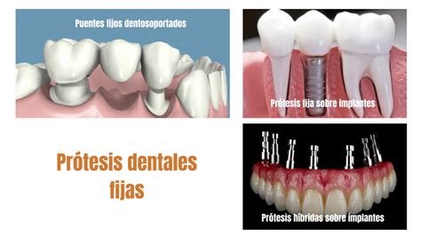 Diferencias Entre Puentes E Implantes Dentales Dental Bar N Cl Nica