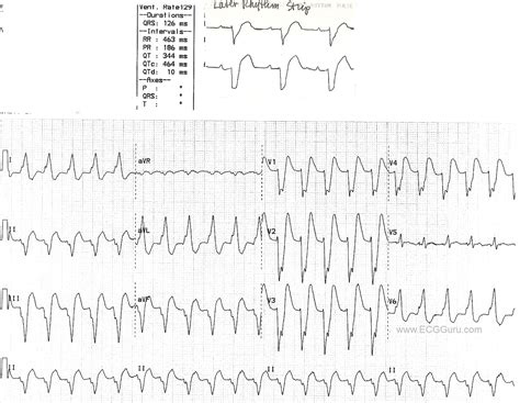 Wide Complex Tachycardia Left Bundle Branch Block With Subsequent