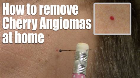 How To Remove Red Skin Dots At Home Quick And Easy Cherry Angioma Treatment Youtube