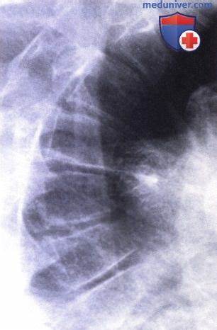 Болезнь шинца диета