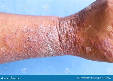 View 6 Different Types Of Skin Allergy Images Maccoxyzesz