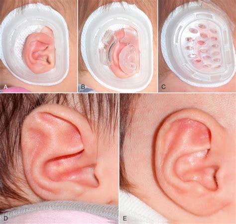 Ears Ny Ear Reconstruction Surgery Ear Molding New York Ny