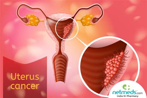 Uterine Cancer Causes Symptoms And Treatment