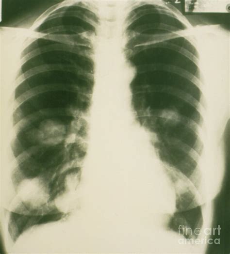 Chest X Ray Showing Cancer Tumours In Lungs Photograph By Dr Howard