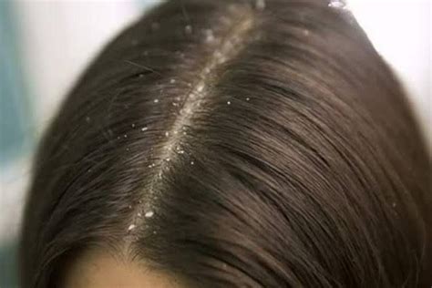 Top 5 Home Remedies For Dandruff Free Hair Wrytin