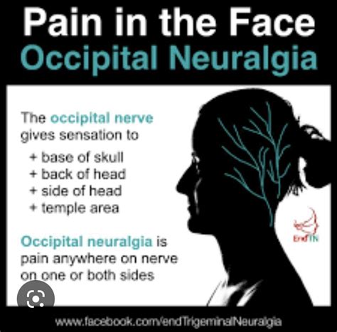 Occipital Or Trigeminal Neuralgia Knowing Their Differences Artofit