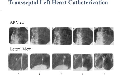 Transseptal Left Heart Catheterization As Viewed By Anteroposterior