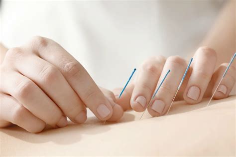 3 Benefits Of Acupuncture In Seattle Elistingz