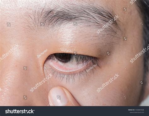 Pallor Palpebral Conjunctiva Southeast Asian Chinese Stock Photo