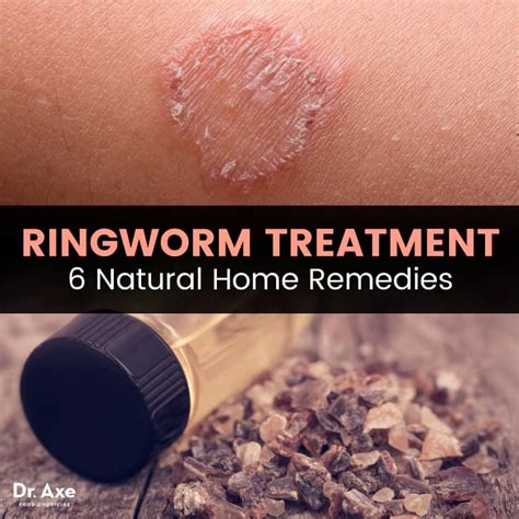 Ringworm Treatment 6 Natural Remedies How To Prevent It Best Pure