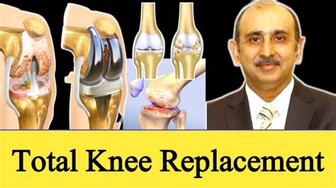 Comlete Knee Class Artificial Knee Replacement Total Knee