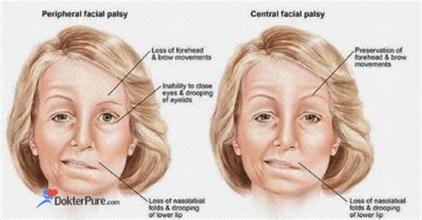 Learn the details so that you can tell them apart. Bell Palsy Disease / Bell S Palsy Versus Stroke What To ...