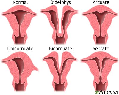 Developmental Disorders Of The Female Genital Tract Information Mount