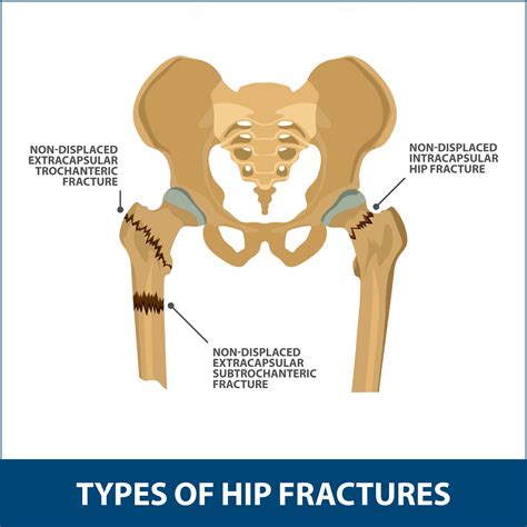 Non Surgical Treatment For Hip Fracture Quotes Trend