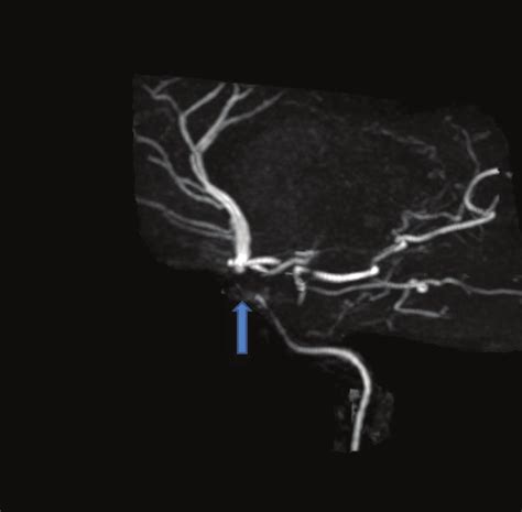 MRA Head Showing A Right Intracranial Internal Carotid Artery Stenosis