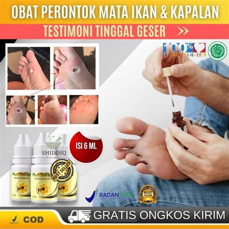 Obat Untuk Menghilangkan Mata Ikan Sampai Ke Akar Obat Alami Perontok Mata Ikan Yang Bengkak