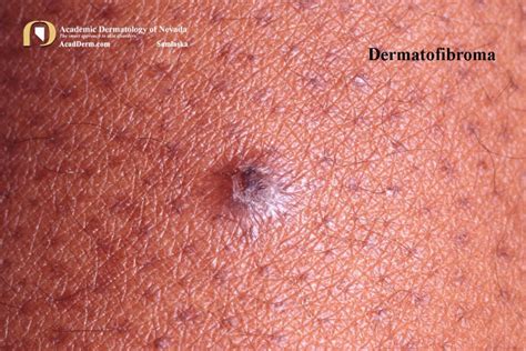 Dermatofibroma Benign Fibrous Histiocytoma Academic Dermatology