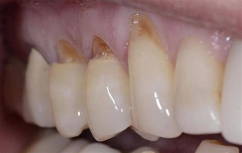 Black Lines On Teeth Near Gums Teethwalls