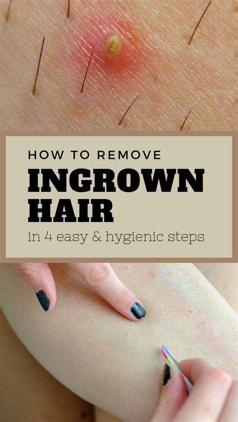 Removed Ingrown Hair Get Rid Of Ingrown Hairs And Razor Bumps With