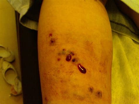 Prolonged Venous Bleeding Due To Traditional Treatment With Leech Bite