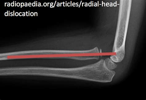 Interpreting Elbow And Forearm Radiographs — Taming The Sru