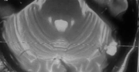 Arachnoid Granulations On Mri Sumers Radiology Blog