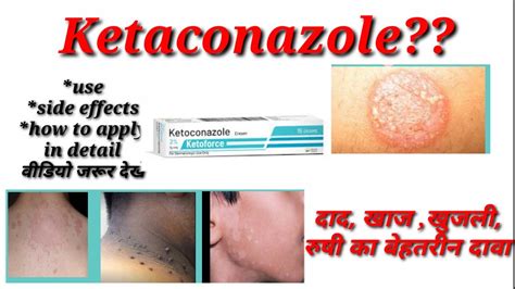Ketoconazole Cream Lotion Usesside Effects How To Apply Youtube