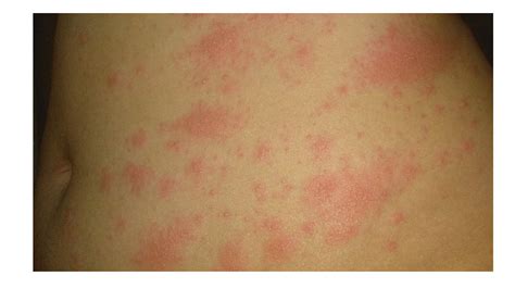 Skin Changes Due To Covid 19 Infections In Children Clinical
